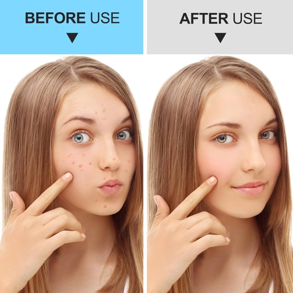 UWOIST Pimple Popper Tool Kit Review 2026: Is This 5-Piece Stainless Steel Set Safe for At-Home Extractions? (H2) If You